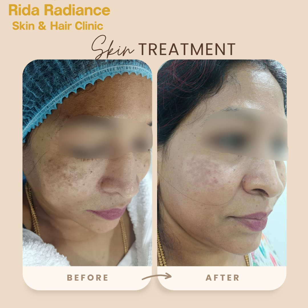 RF Microneedling before and after